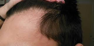 Does Telogen effluvium affect top part of the scalp more than other areas?