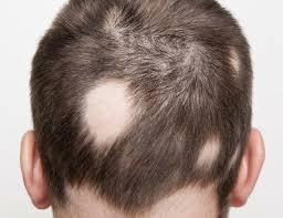 How dangerous is Alopecia Areata?