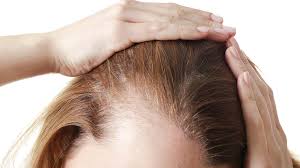 How much hair would you lose on drug-induced telogen effluvium?