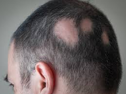What is the best shampoo to use for Alopecia Areata?