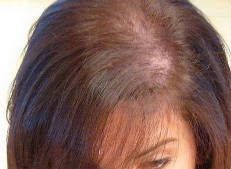 With alopecia areata, does hair grow back on its own?