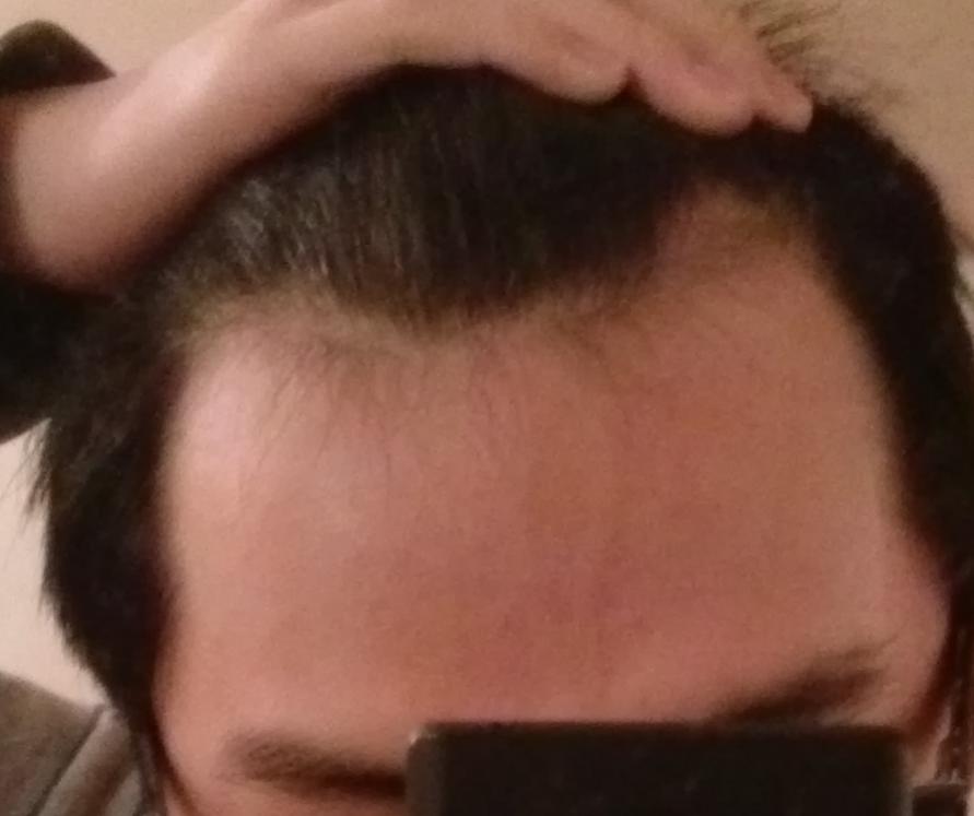 How do I stop my hairline from receding?