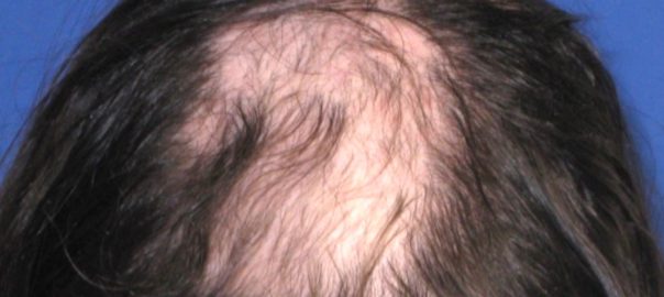 What is Alopecia Areata or AA?
