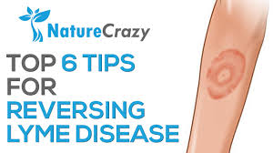 Top 6 Tips For Reversing Lyme Disease