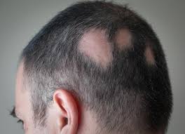 Do you or have you had alopecia areata? If so, what did you do to grow your hair back?