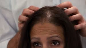 Does minoxidil help with hair growth for women with PCOS?