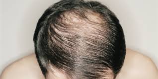 Can I change my DNA to stop hair loss?