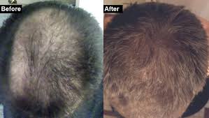 Aside from Rogaine and finasteride, how can I regrow and thicken my hair?