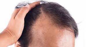 What are the best treatments to cure alopecia areata?