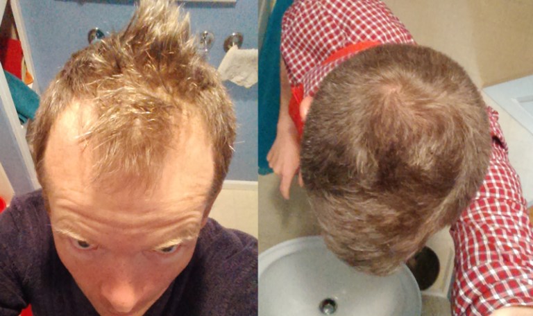 Are you suffering/suffered with alopecia areata? How many months (days exactly) will it take to regrow my hair?