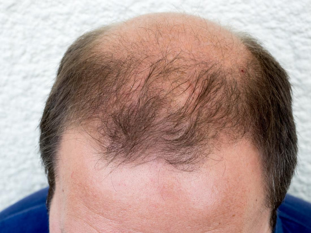 An In-Depth Look at Stress Related Telogen Effluvium Hair Loss