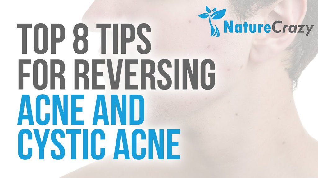 Nature Crazy’s Top 8 Tips For Reversing Acne and Cystic Acne