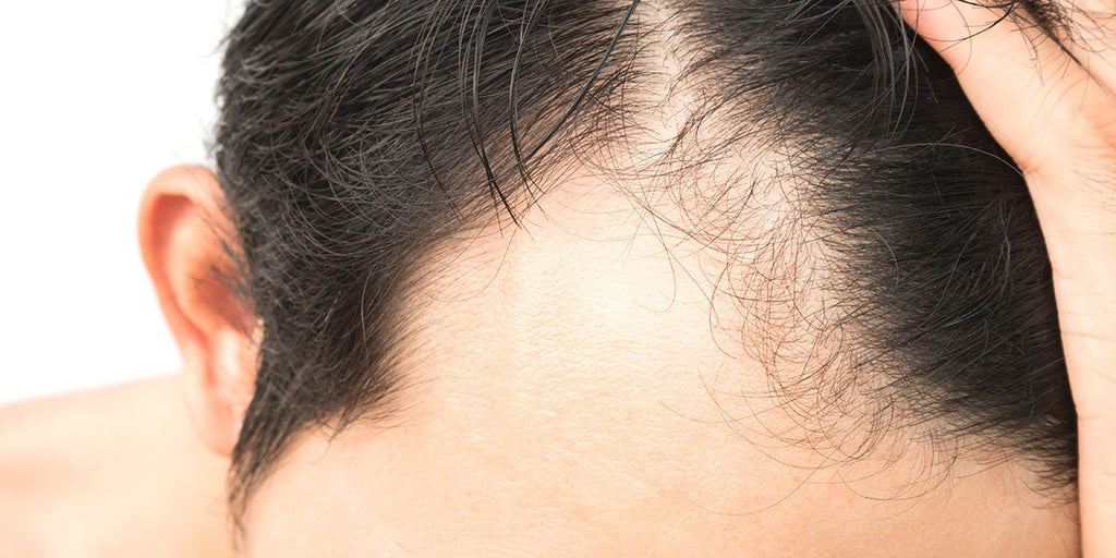 What are remedies to cure alopecia areata?